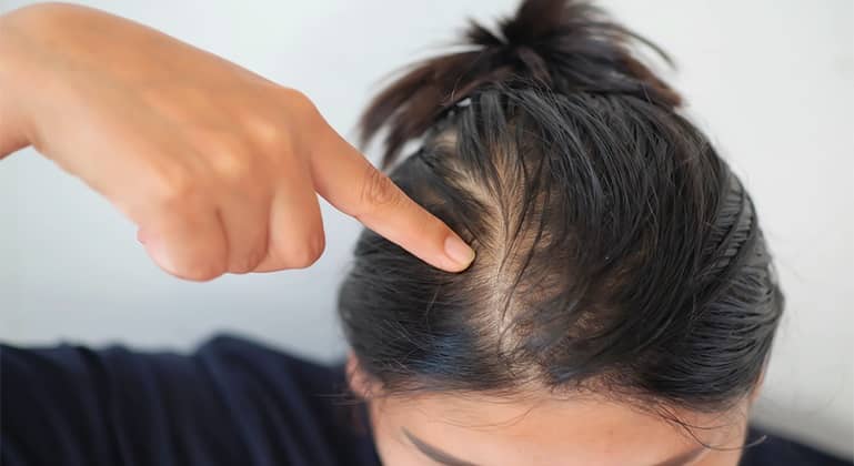 Thinning hair: Causes, types, treatment, and remedies
