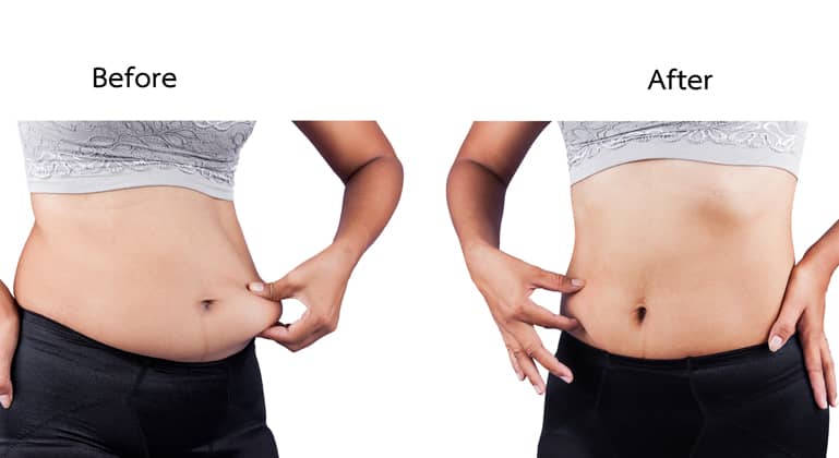 CoolSculpting to Tone Stomach, Thighs, and Other Flabby Areas 