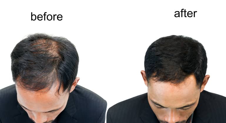 5 Things To Consider Before And After The Hair Transplant Treatment 