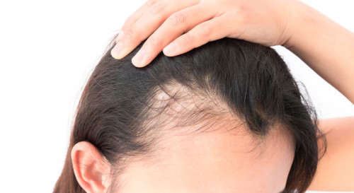 How to Improve Thinning Hair: Causes, Treatments, Vitamins, and More