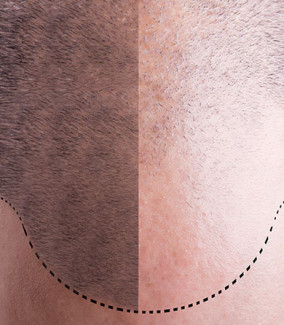 البلازما الغنية بالصفائح الدموية